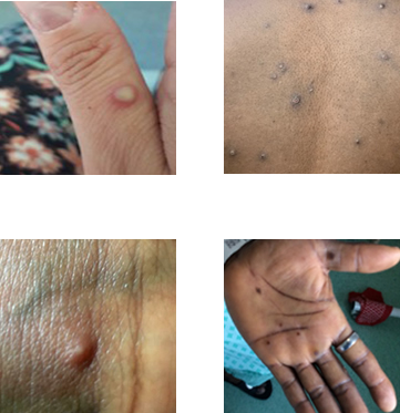 mpox images